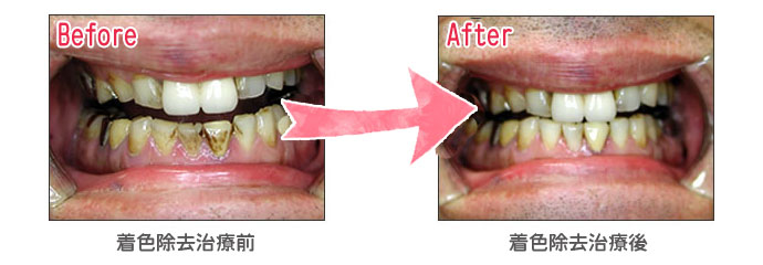 ステイン（着色）除去（自費治療）