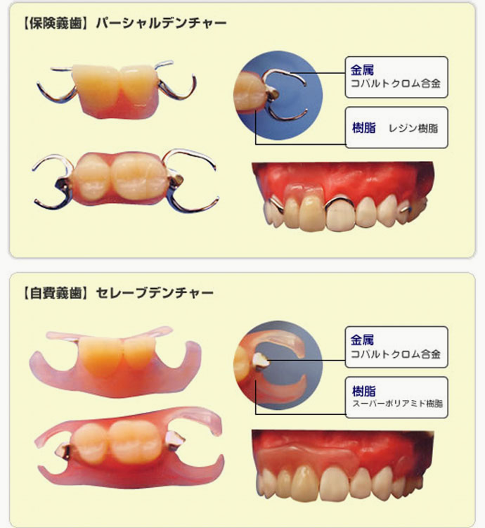 保険義歯と自費義歯の違いの例